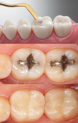 immediate dental implants