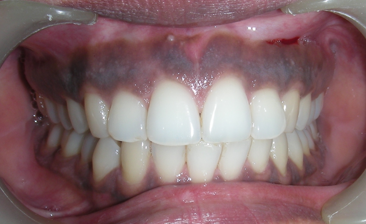 dental implants india