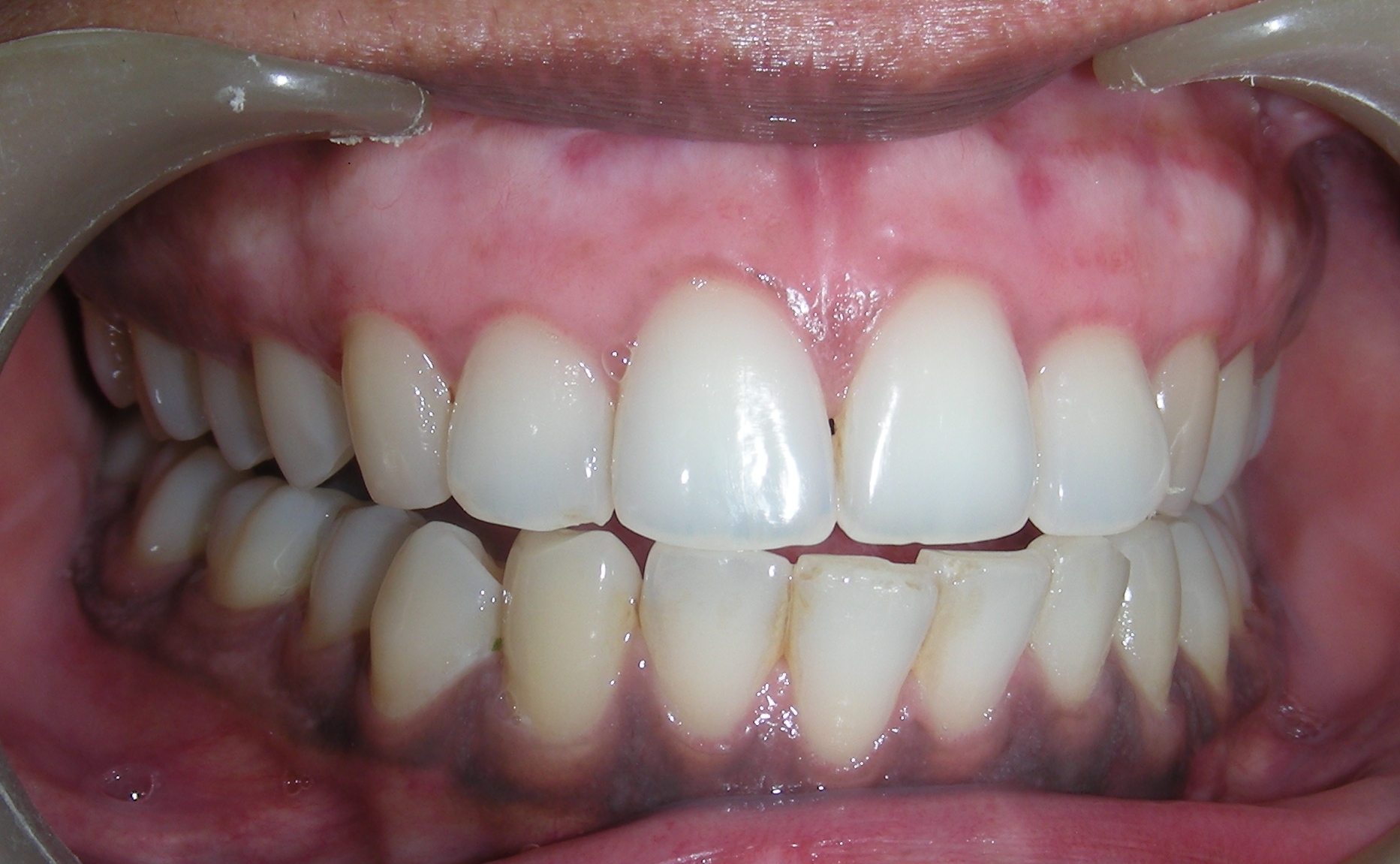 Low cost dental implants india