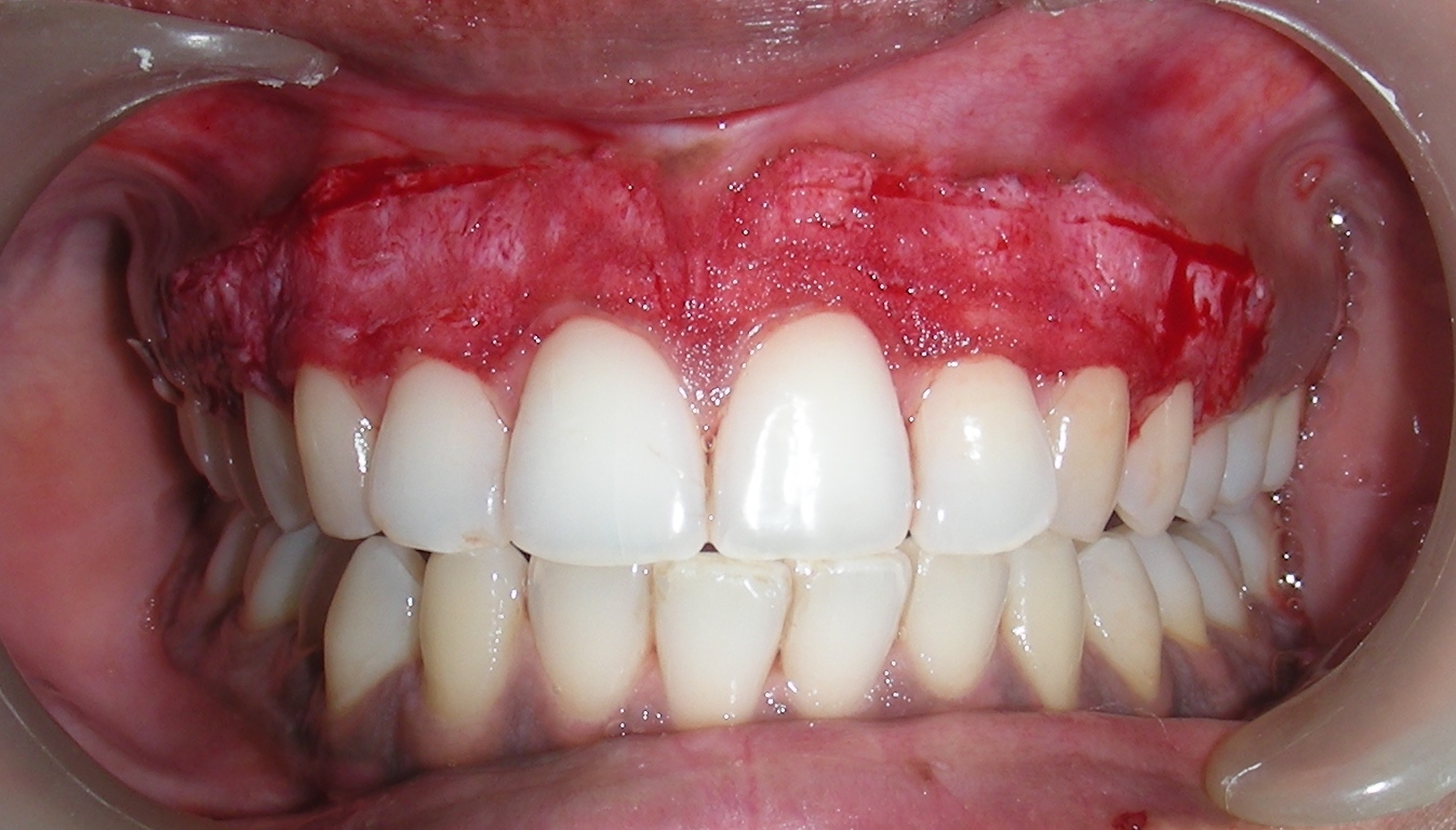 Affordable Dental Implants