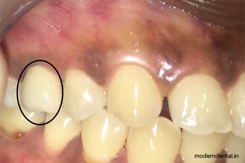 Dental Implants India