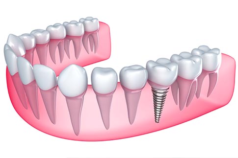 Affordable Dental Implants