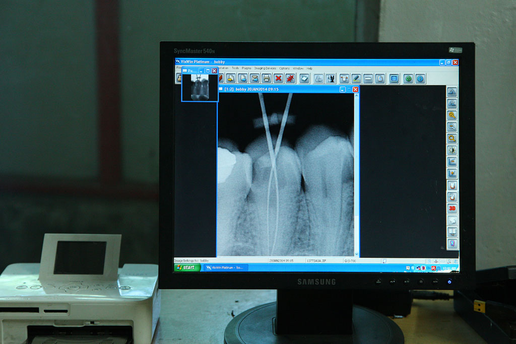 dental implants india