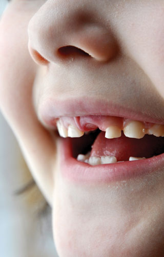 dental implant cost india