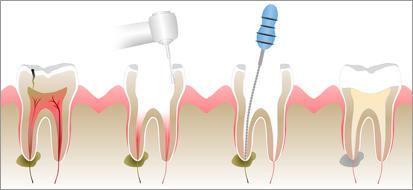 dental implants kerala