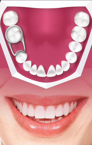 dental implants kerala