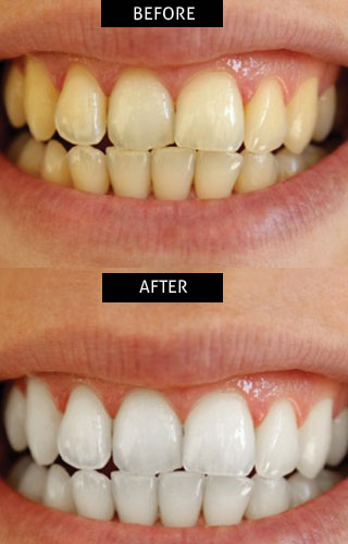 Dental tourism india